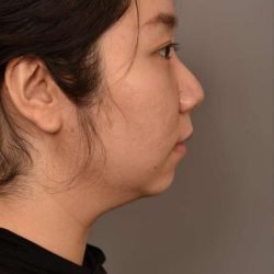 Chin Implant Before & After Patient #2234