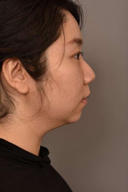 Chin Implant Before & After Patient #2234