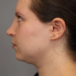 Chin Implant Before & After Patient #2243
