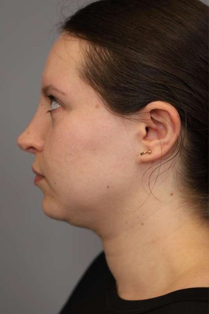 Chin Implant Before & After Patient #2243