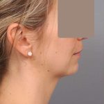Chin Implant Before & After Patient #2253