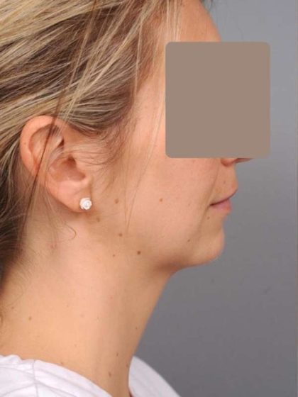 Chin Implant Before & After Patient #2253