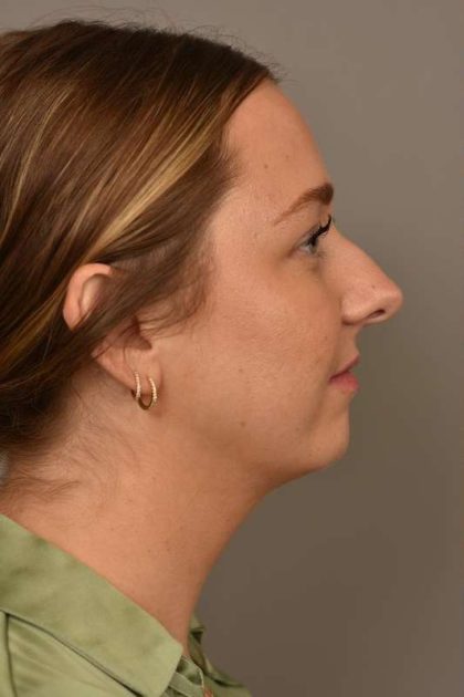 Chin Implant Before & After Patient #2262