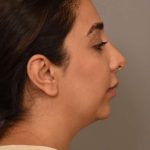 Chin Implant Before & After Patient #2269