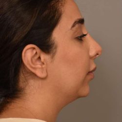 Chin Implant Before & After Patient #2269