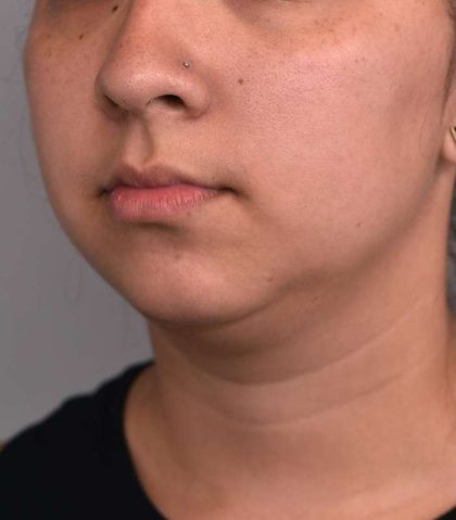 Chin Implant Before & After Patient #2278