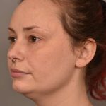 Facial Contouring Before & After Patient #2281