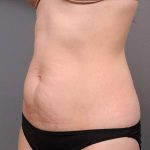 Tummy Tuck Before & After Patient #436