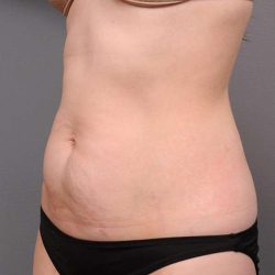 Tummy Tuck Before & After Patient #436