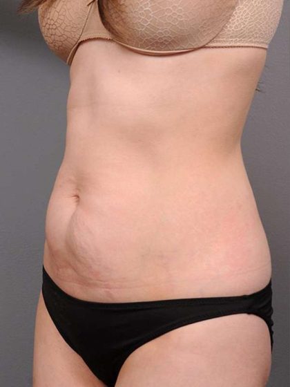 Tummy Tuck Before & After Patient #436