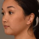 Facial Contouring Before & After Patient #2284