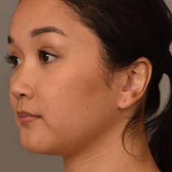 Facial Contouring Before & After Patient #2284