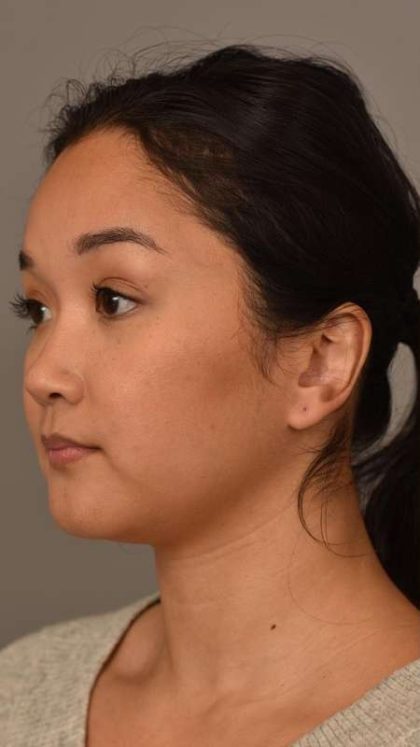 Facial Contouring Before & After Patient #2284