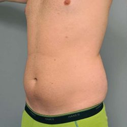 Liposuction For Men Before & After Patient #2294
