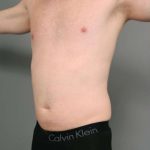 Liposuction For Men Before & After Patient #2301