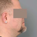 Liposuction For Men Before & After Patient #2308