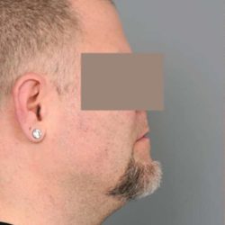 Liposuction For Men Before & After Patient #2308