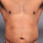 Liposuction For Men Before & After Patient #2315
