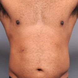 Liposuction For Men Before & After Patient #2315