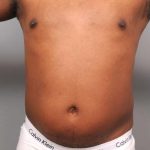 Liposuction For Men Before & After Patient #2330