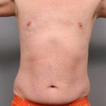 Liposuction For Men Before & After Patient #2337