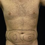 Liposuction For Men Before & After Patient #2347