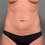 Tummy Tuck Before & After Patient #443