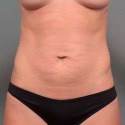 Tummy Tuck Before & After Patient #443