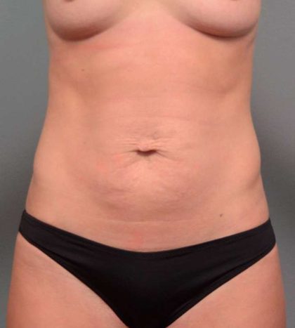 Tummy Tuck Before & After Patient #443