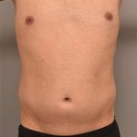 Liposuction For Men Before & After Patient #2358