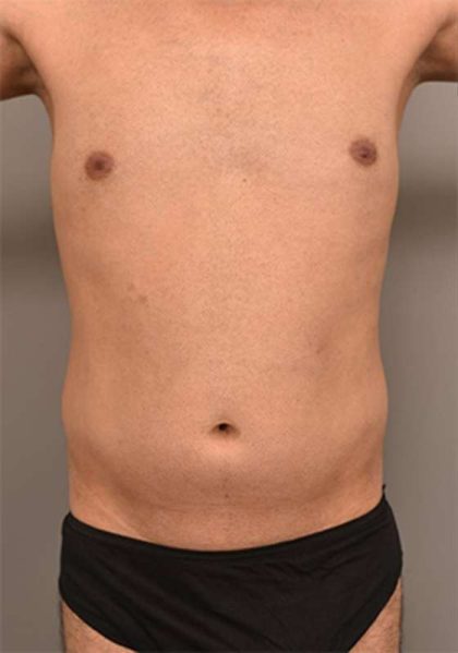 Liposuction For Men Before & After Patient #2358