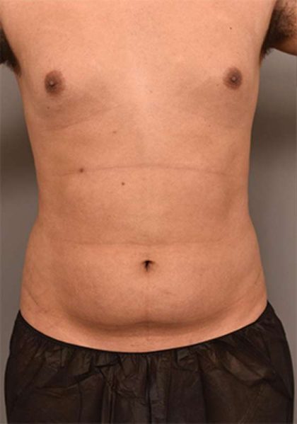 Liposuction For Men Before & After Patient #2369