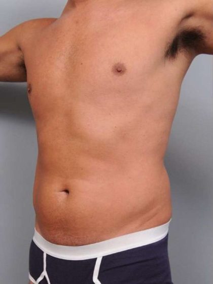 Liposuction For Men Before & After Patient #2386
