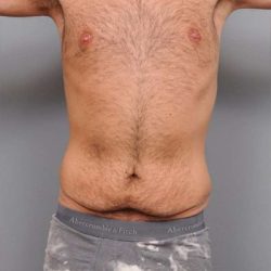 Tummy Tuck For Men Before & After Patient #2394