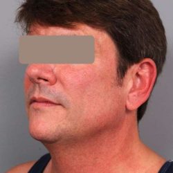 Neck Liposuction For Men Before & After Patient #2419
