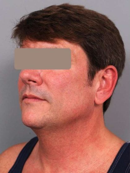 Neck Liposuction For Men Before & After Patient #2419