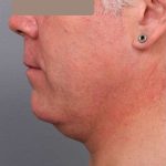Neck Liposuction For Men Before & After Patient #2426
