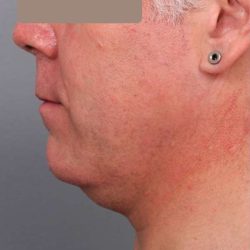 Neck Liposuction For Men Before & After Patient #2426