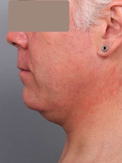 Neck Liposuction For Men Before & After Patient #2426