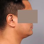 Neck Liposuction For Men Before & After Patient #2438