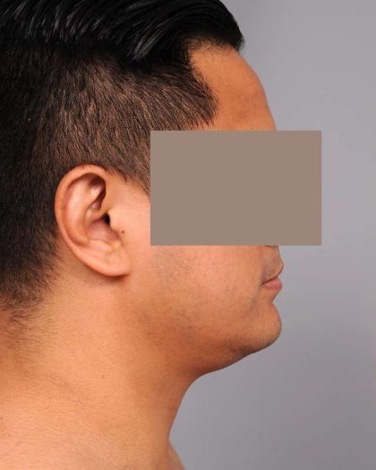 Neck Liposuction For Men Before & After Patient #2438