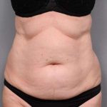 Tummy Tuck Before & After Patient #450