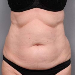 Tummy Tuck Before & After Patient #450