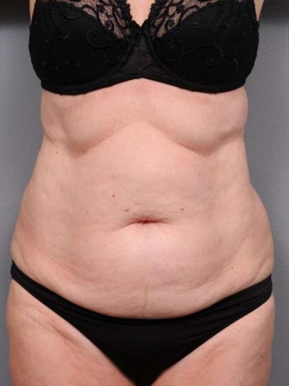 Tummy Tuck Before & After Patient #450