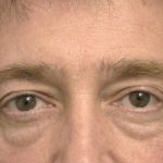 Eyelid Surgery For Men Before & After Patient #2476