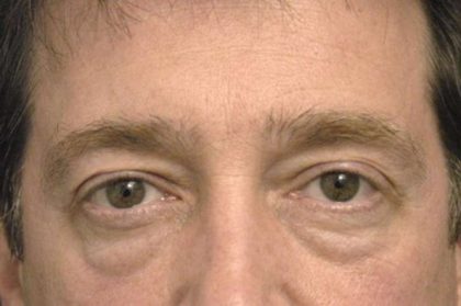 Eyelid Surgery For Men Before & After Patient #2476