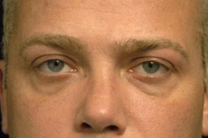 Eyelid Surgery For Men Before & After Patient #2481