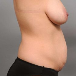 Mommy Makeover Before & After Patient #2497