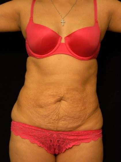 Mommy Makeover Before & After Patient #2513