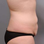 Tummy Tuck Before & After Patient #463
